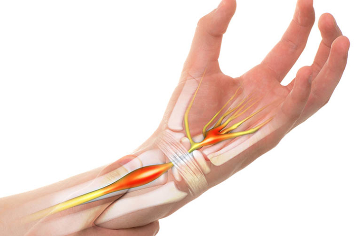 Tê tay chân thường xuyên có nguy hiểm không?
