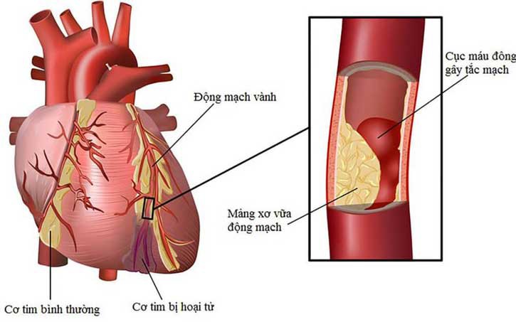 5 cách đơn giản ngăn ngừa bệnh tim và đột quỵ