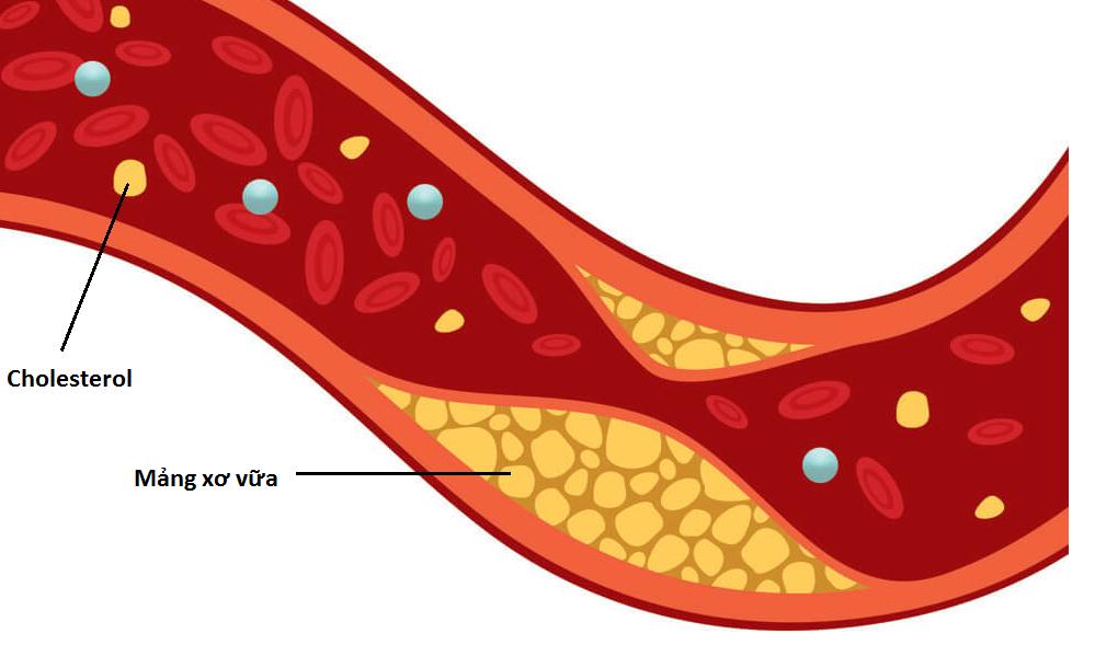 5 chất dinh dưỡng giúp loại bỏ cholesterol xấu- Ảnh 1.