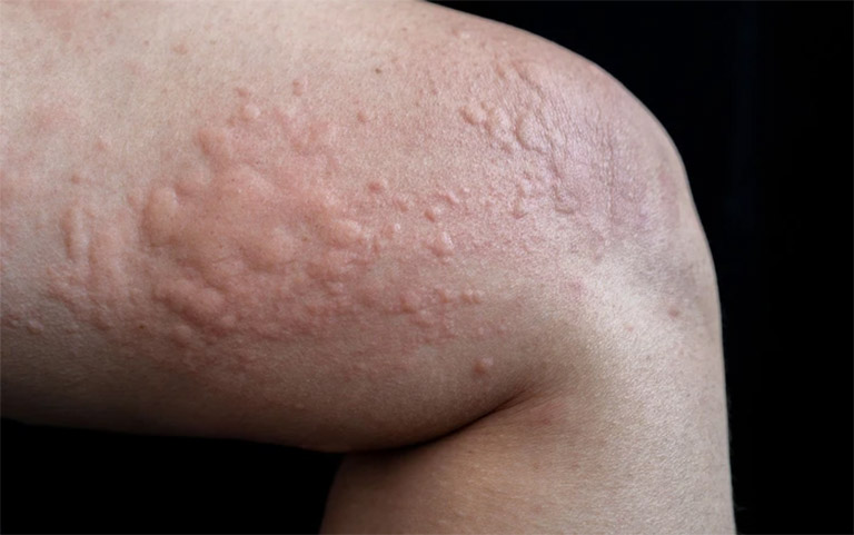 Cách trị nổi mề đay, giảm ngứa rát tại nhà hiệu quả- Ảnh 1. Cách trị nổi mề đay, giảm ngứa rát tại nhà hiệu quả- Ảnh 1.