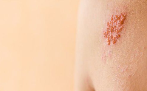 Thuốc điều trị đau và sẹo do zona thần kinh