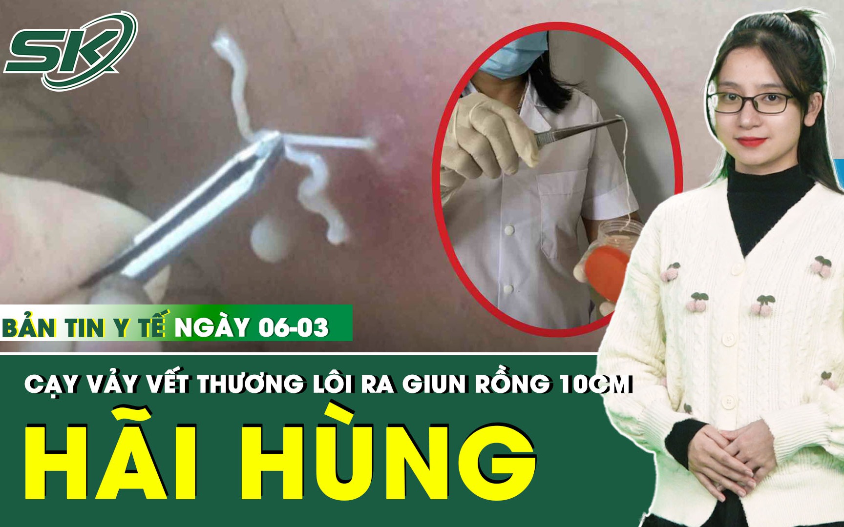 Bản Tin Y Tế 6/3: Cạy vảy vết thương, người đàn ông hãi hùng lôi ra con giun rồng dài 10cm 