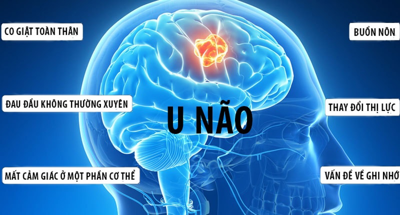 Dấu hiệu nhận biết sớm bệnh u não khiến diễn viên Quý Bình đột ngột qua đời ở tuổi 42- Ảnh 1.