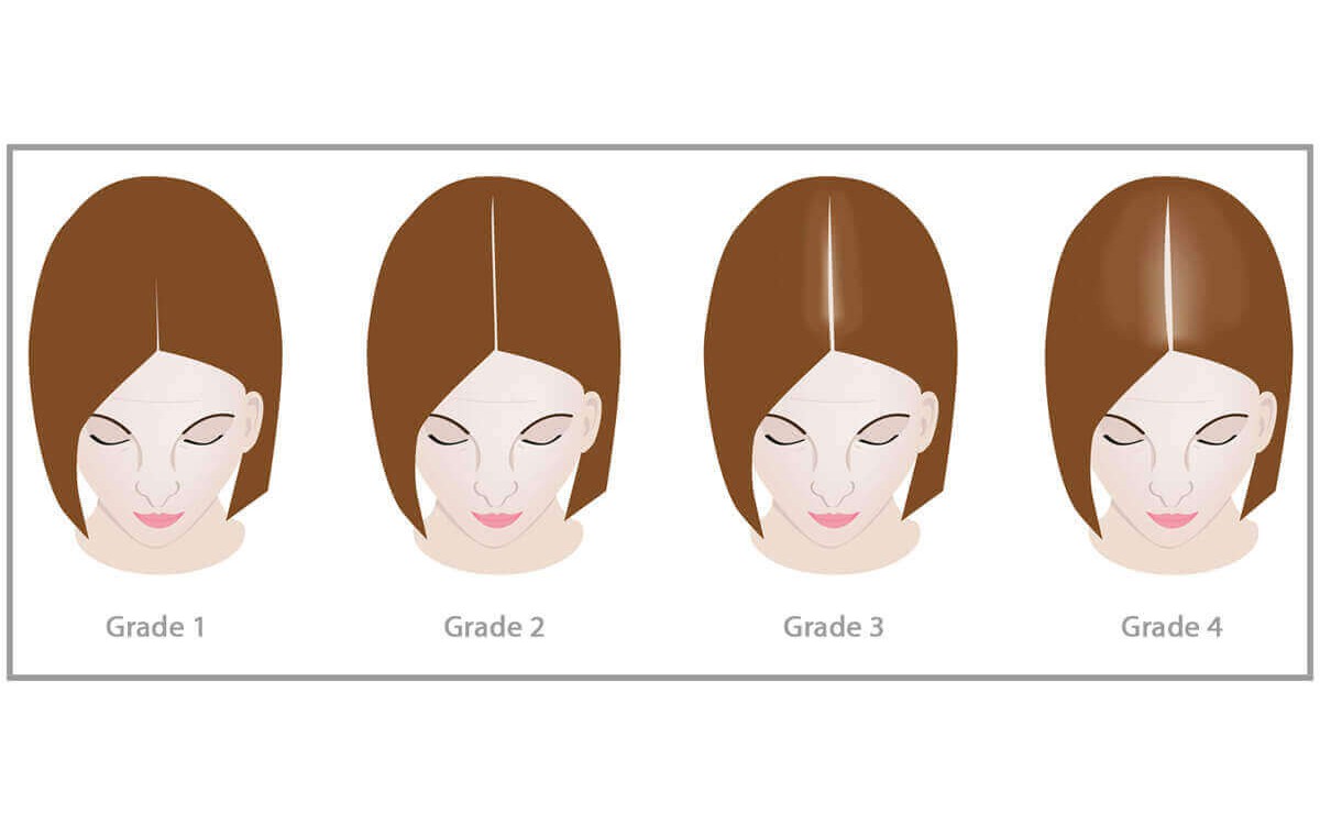 Những lý do rụng tóc thời kỳ mãn kinh và cách cải thiện