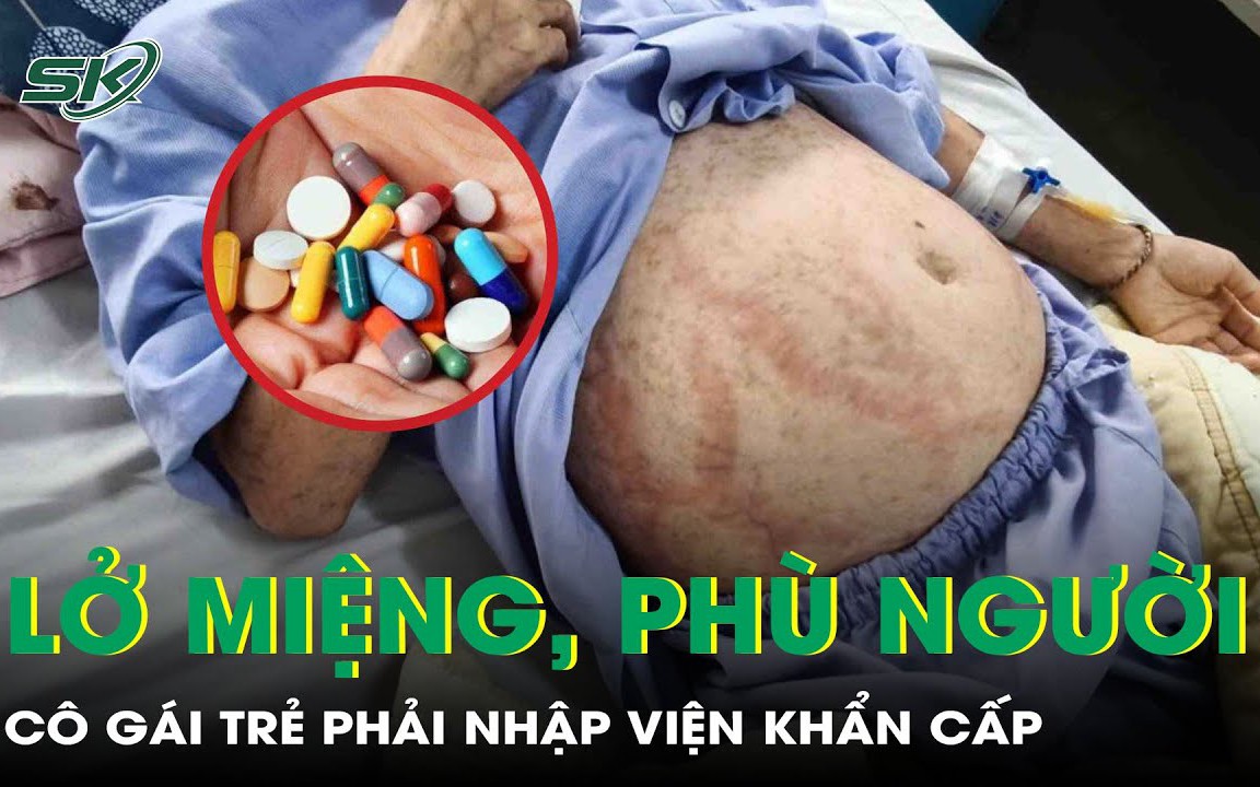 Uống thuốc đau răng, thuốc cảm, cô gái trẻ lở loét vùng sinh dục, sưng phù toàn thân