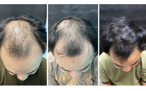 Xu hướng điều trị rụng tóc mới năm 2025