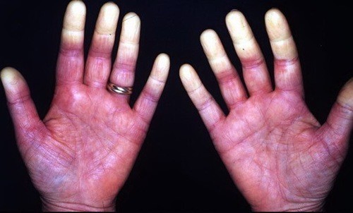 Một số thuốc và phương pháp điều trị Hội chứng Raynaud- Ảnh 1. Khám và điều trị hội chứng Raynaud