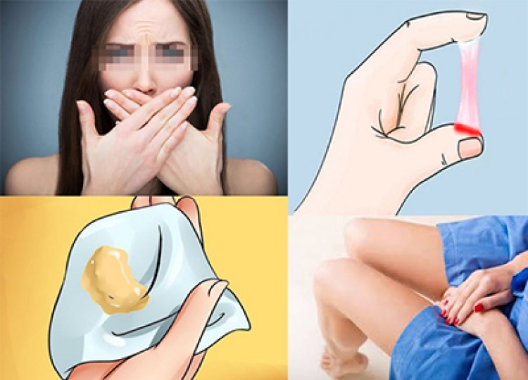 Khí hư màu trắng kem - nguyên nhân và cách điều trị
