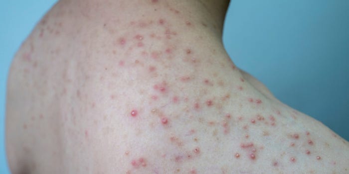 người đàn ông bị viêm nang lông