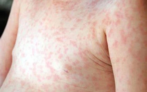 Xử lý triệt để các ổ dịch sốt xuất huyết ngay từ khi xuất hiện