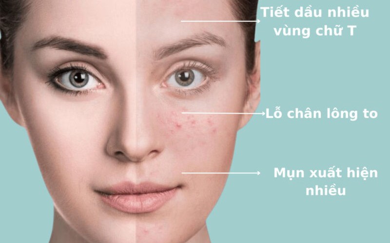 Cách làm đẹp cho da dầu, có mụn ẩn