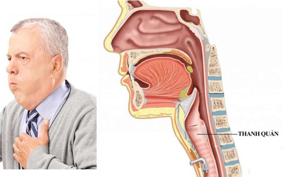Liệt cơ mở thanh quản: Nguyên nhân, biểu hiện, cách điều trị và phòng bệnh