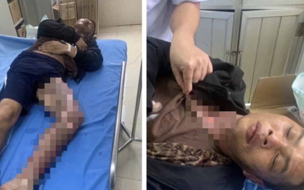 Leo trạm biến áp cắt trộm dây điện, hai người bị điện giật bỏng nặng