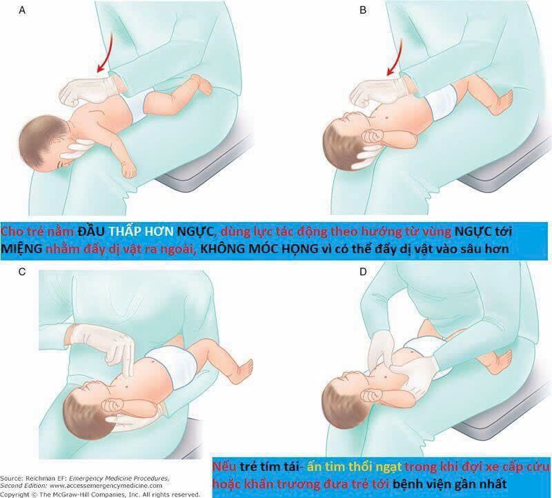 Khuyến cáo quan trọng xử trí, phòng ngừa hóc dị vật ở trẻ- Ảnh 3. Khuyến cáo quan trọng xử trí, phòng ngừa hóc dị vật ở trẻ- Ảnh 3.