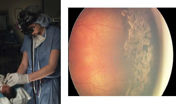 Bệnh lý võng mạc trẻ sinh non có thể gây mù lòa nếu không được điều trị kịp thời- Ảnh 4. Bệnh lý võng mạc trẻ sinh non có thể gây mù lòa nếu không được điều trị kịp thời- Ảnh 4.