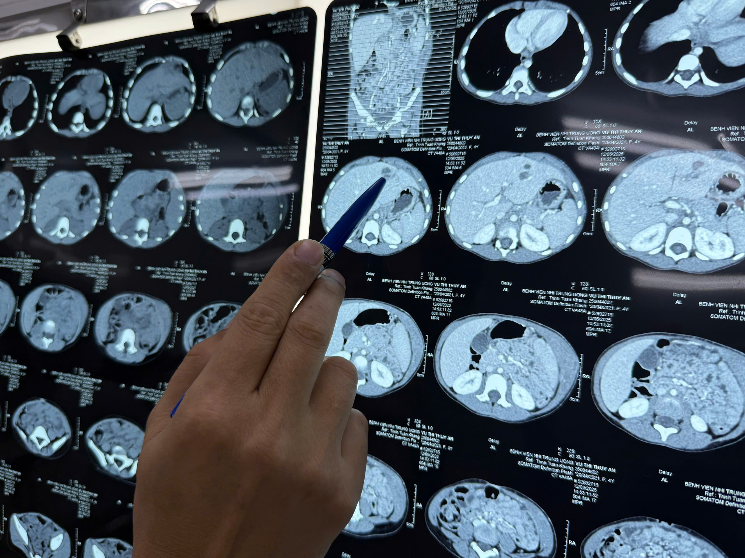 Thói quen nướng cua đá ăn, bé gái 4 tuổi đồng nhiễm nhiều loại giun sán gan, phổi- Ảnh 2.