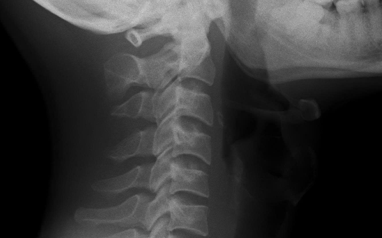 Đau cột sống cổ âm ỉ 5 tháng, nam thanh niên 26 tuổi phát hiện viêm cột sống dính khớp- Ảnh 4.