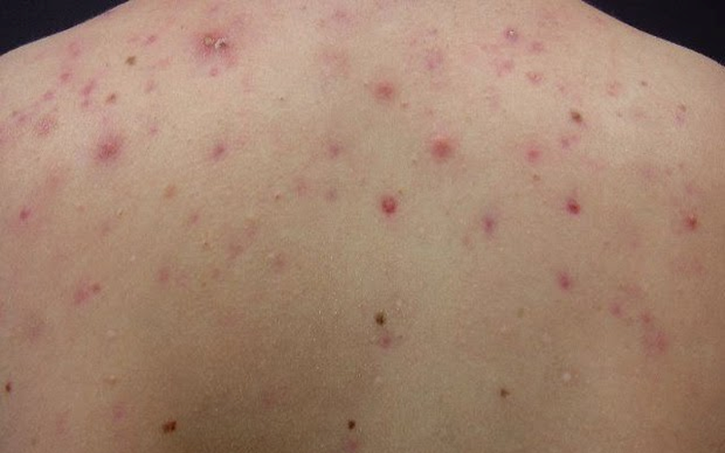 Nóng gan gây nổi mụn lưng?