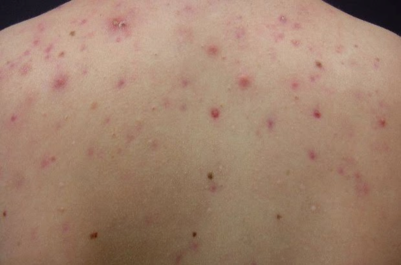 Nóng gan gây nổi mụn lưng?- Ảnh 1. Nóng gan gây nổi mụn lưng?- Ảnh 1.