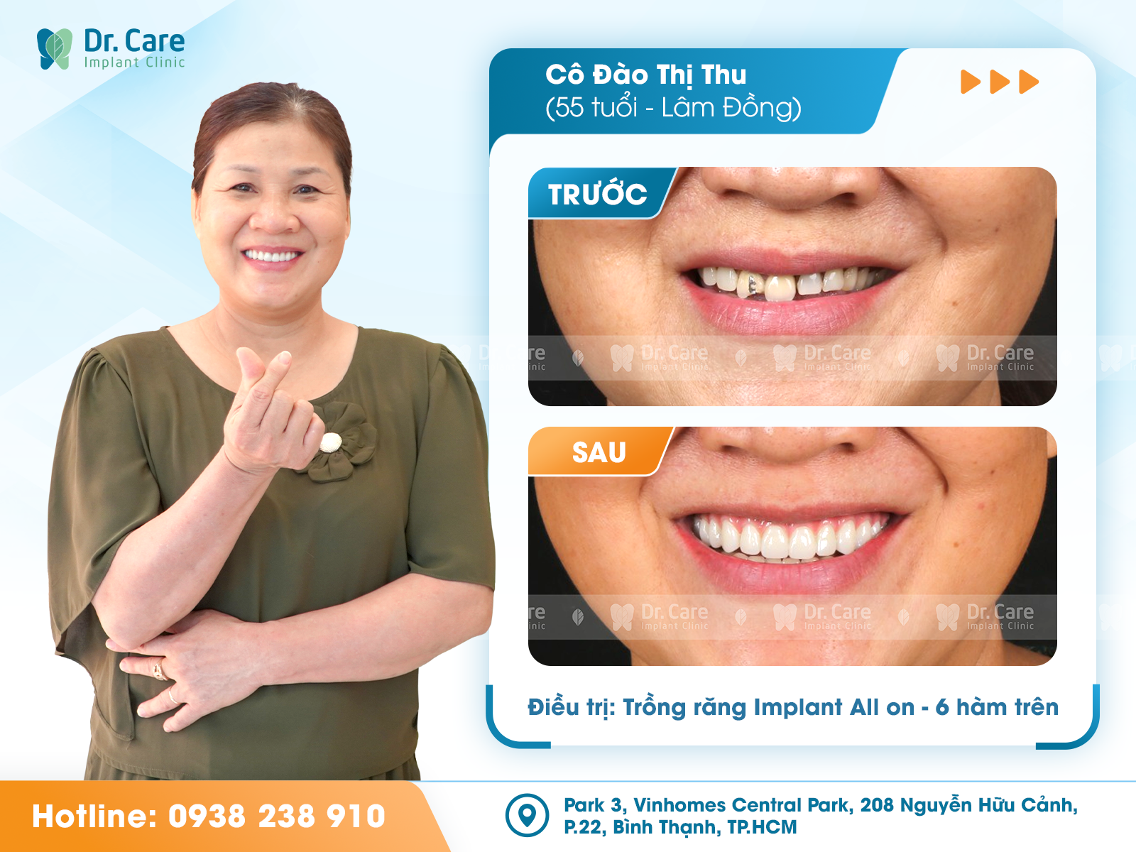 Trồng răng Implant với công nghệ hiện đại tại Dr. Care- Ảnh 2. Trồng răng Implant với công nghệ hiện đại tại Dr. Care- Ảnh 2.
