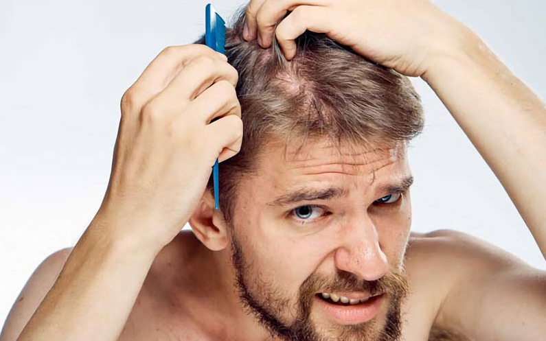 Rụng tóc ở nam giới và giải pháp khắc phục