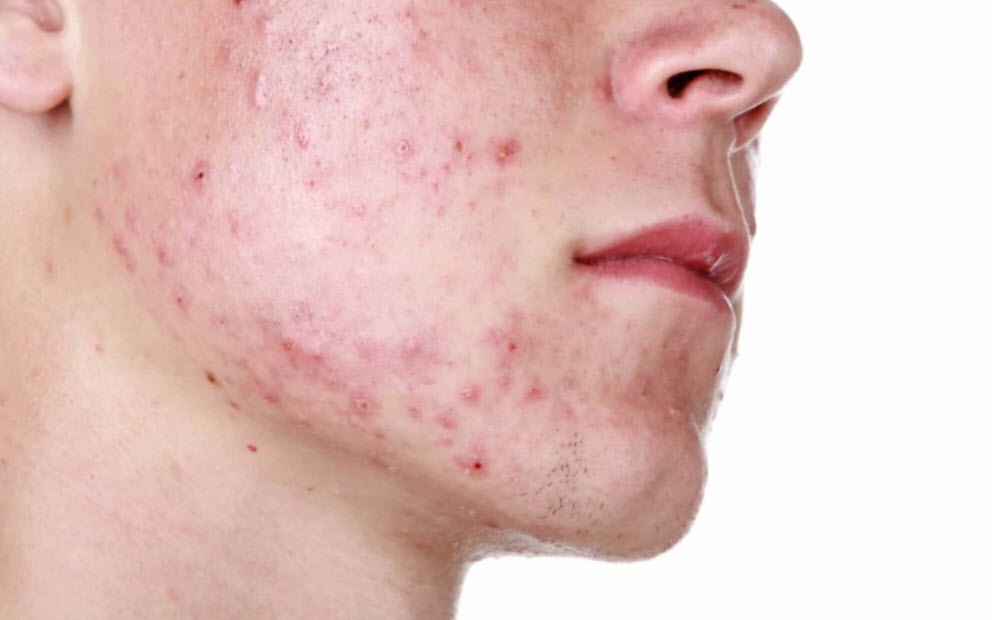 Cách trị mụn trứng cá hiệu quả nhất