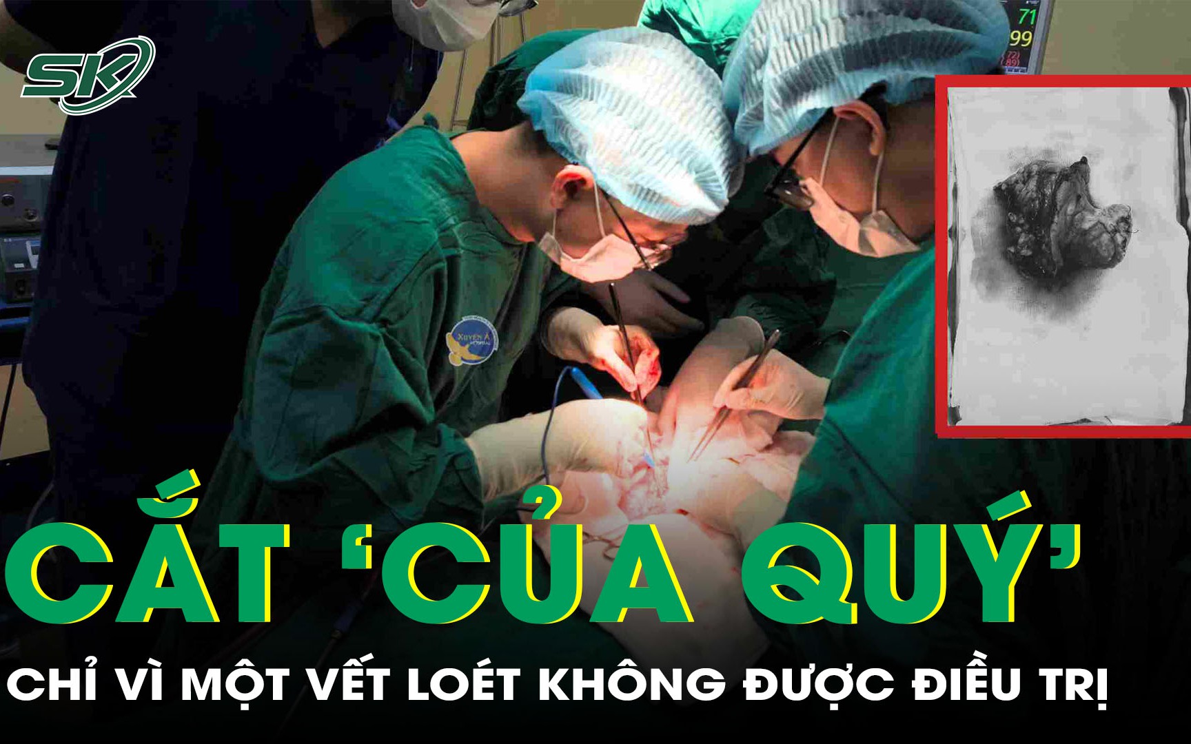 Từ một vết loét, người đàn ông phải cắt toàn bộ "của quý" vì ung thư dương vật