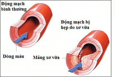 Câu hỏi thường gặp về bệnh xơ vữa động mạch não- Ảnh 3. Câu hỏi thường gặp về bệnh xơ vữa động mạch não- Ảnh 3.