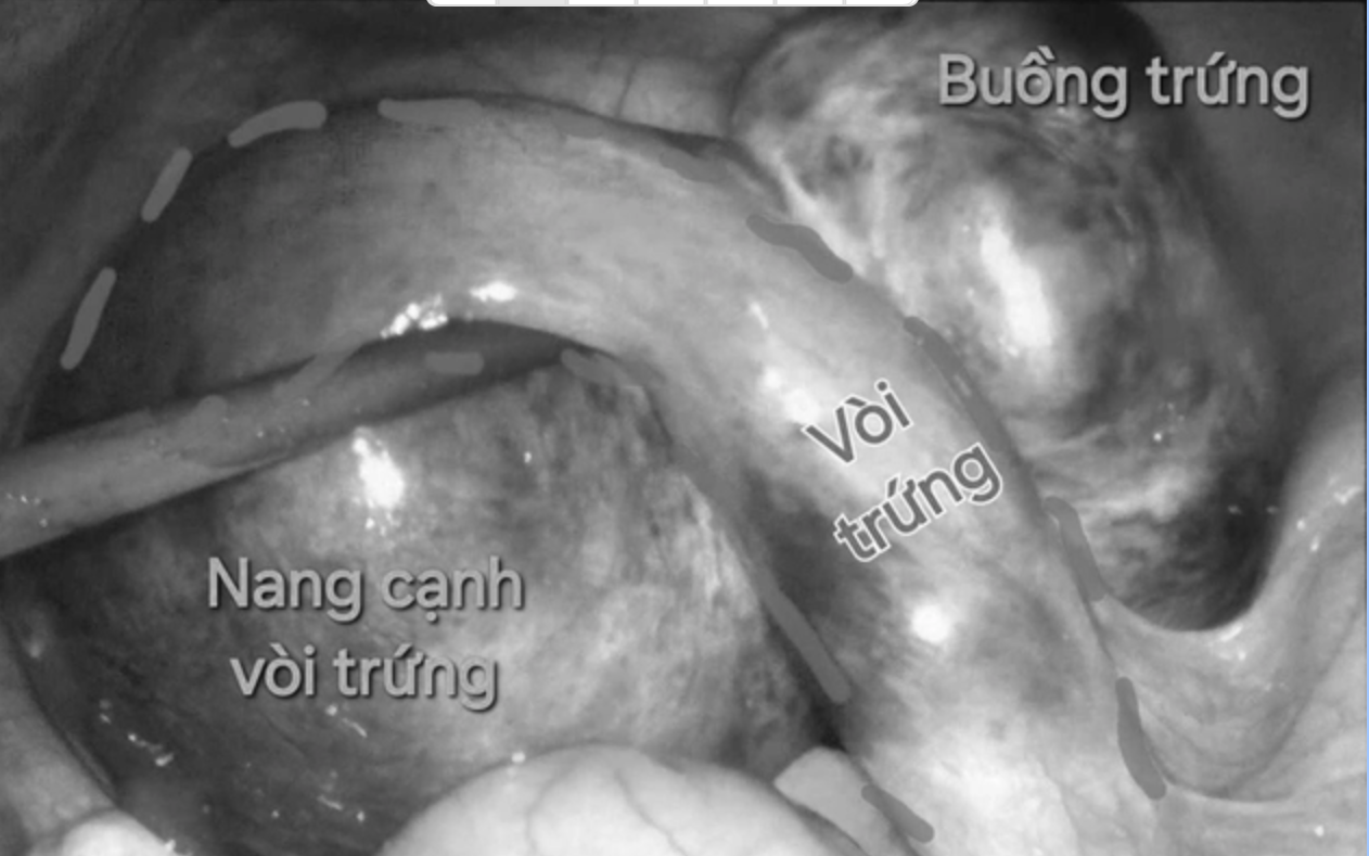 Bệnh viện tuyến tỉnh phối hợp với chuyên gia Úc phẫu thuật dị tật tiết niệu cho bé trai 6 tuổi- Ảnh 2.