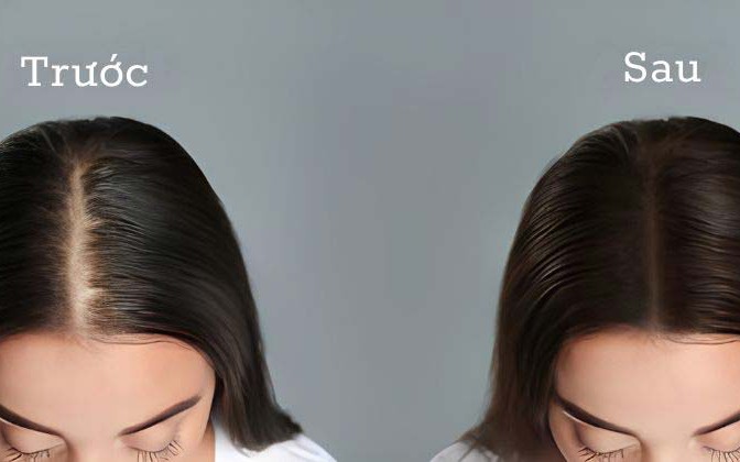 3 cách gội đầu giảm rụng tóc
