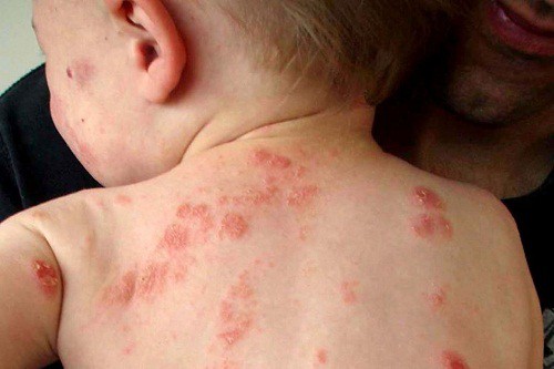 Trẻ bị viêm da dị ứng khi nào cần gặp bác sĩ?- Ảnh 1. Trẻ bị viêm da dị ứng khi nào cần gặp bác sĩ?- Ảnh 1.