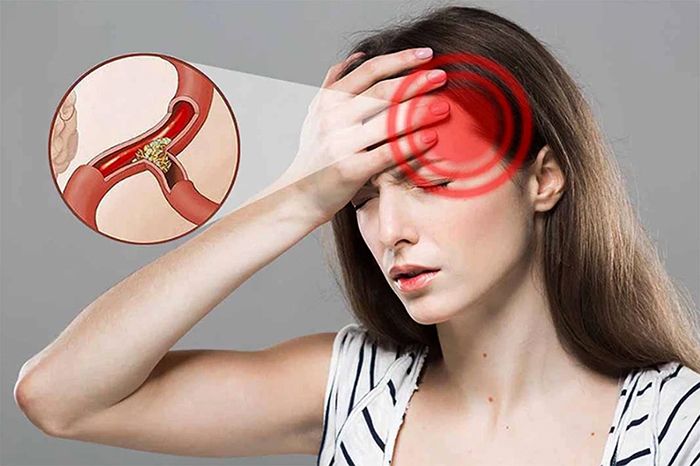 Những dấu hiệu thiếu máu não- Ảnh 1. Những dấu hiệu thiếu máu não- Ảnh 1.