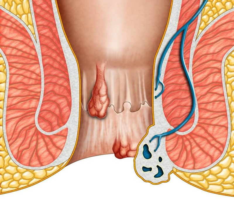 6 thói quen dễ gây bệnh trĩ mà nhiều người mắc phải- Ảnh 1. 6 thói quen dễ gây bệnh trĩ mà nhiều người mắc phải- Ảnh 1.