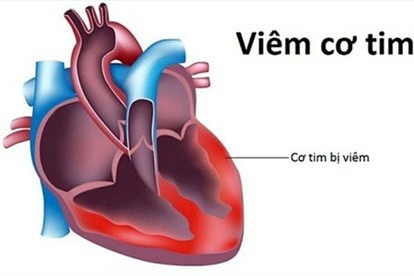 Chẩn đoán và điều trị viêm cơ tim | Vinmec