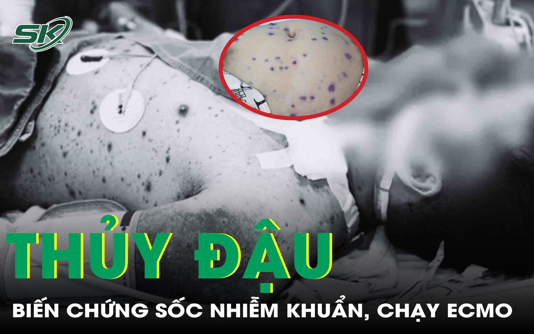 Biến chứng thủy đậu: Một ca xin về vì sốc kháng trị, một ca phải lọc máu, chạy ECMO 