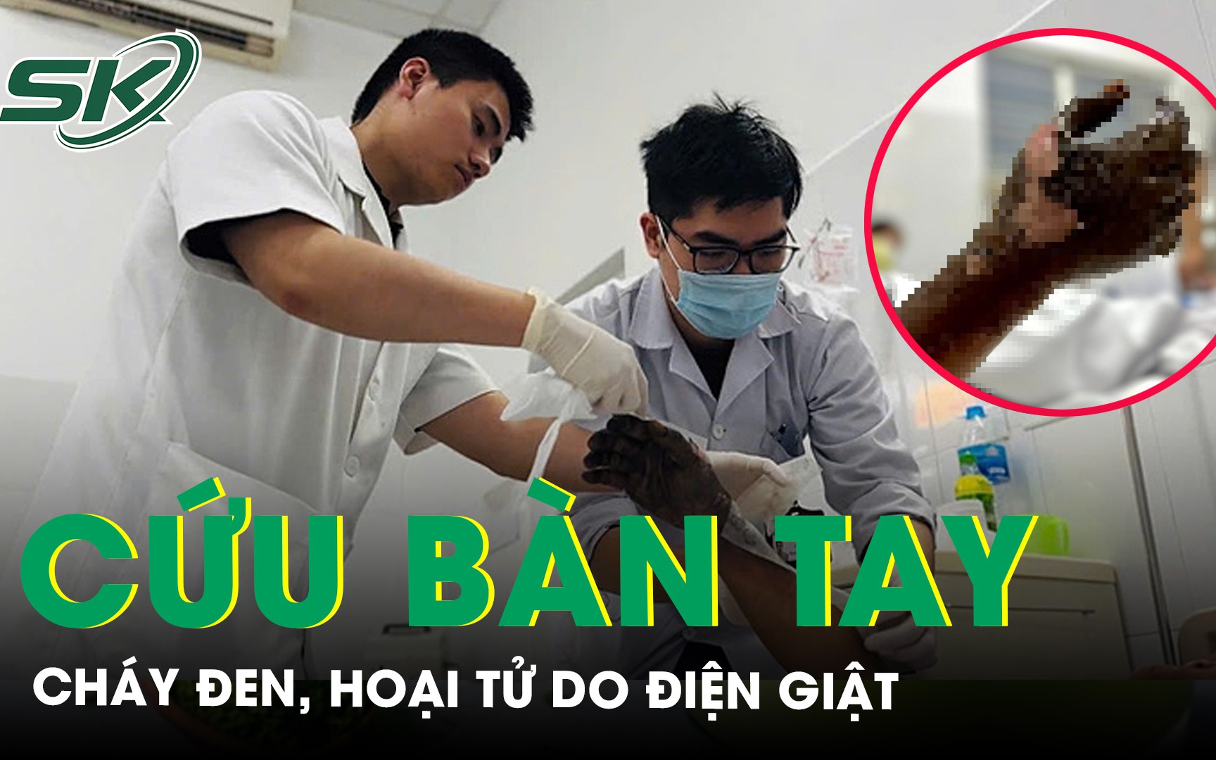 Cứu chữa kịp thời bàn tay cháy đen, hoại tử do điện giật