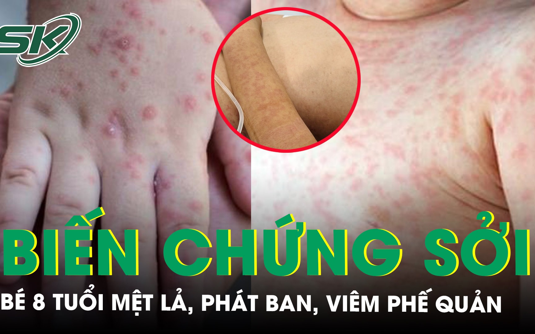 Bé trai 8 tuổi mắc sởi biến chứng viêm phế quản 