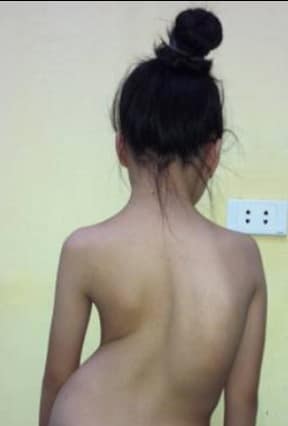 Tin vui cho trẻ mắc bệnh lý gù, vẹo cột sống- Ảnh 2. Tin vui cho trẻ mắc bệnh lý gù, vẹo cột sống- Ảnh 2.