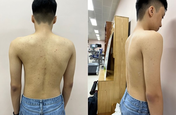 Tin vui cho trẻ mắc bệnh lý gù, vẹo cột sống- Ảnh 1. Tin vui cho trẻ mắc bệnh lý gù, vẹo cột sống- Ảnh 1.