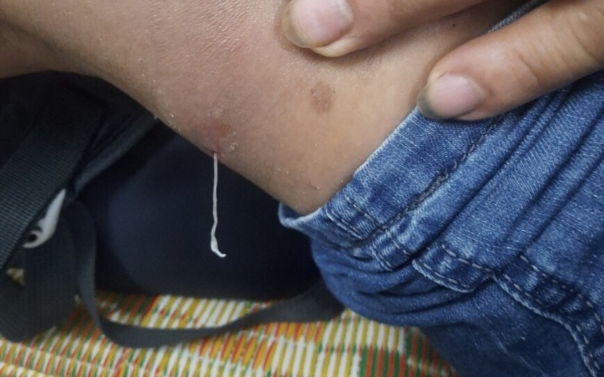 Ăn gỏi cá, uống nước lã dễ nhiễm giun rồng dài hàng mét, cực nguy hiểm