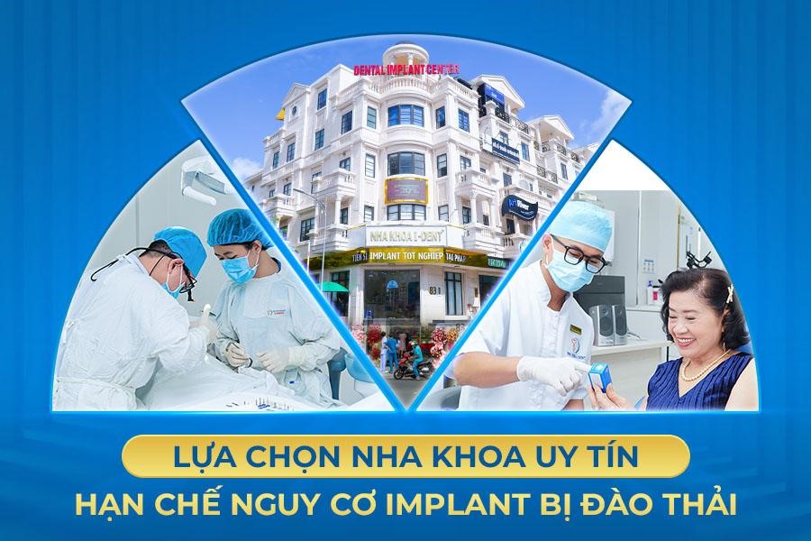 Implant bị đào thải do đâu? Cách khắc phục?- Ảnh 3.