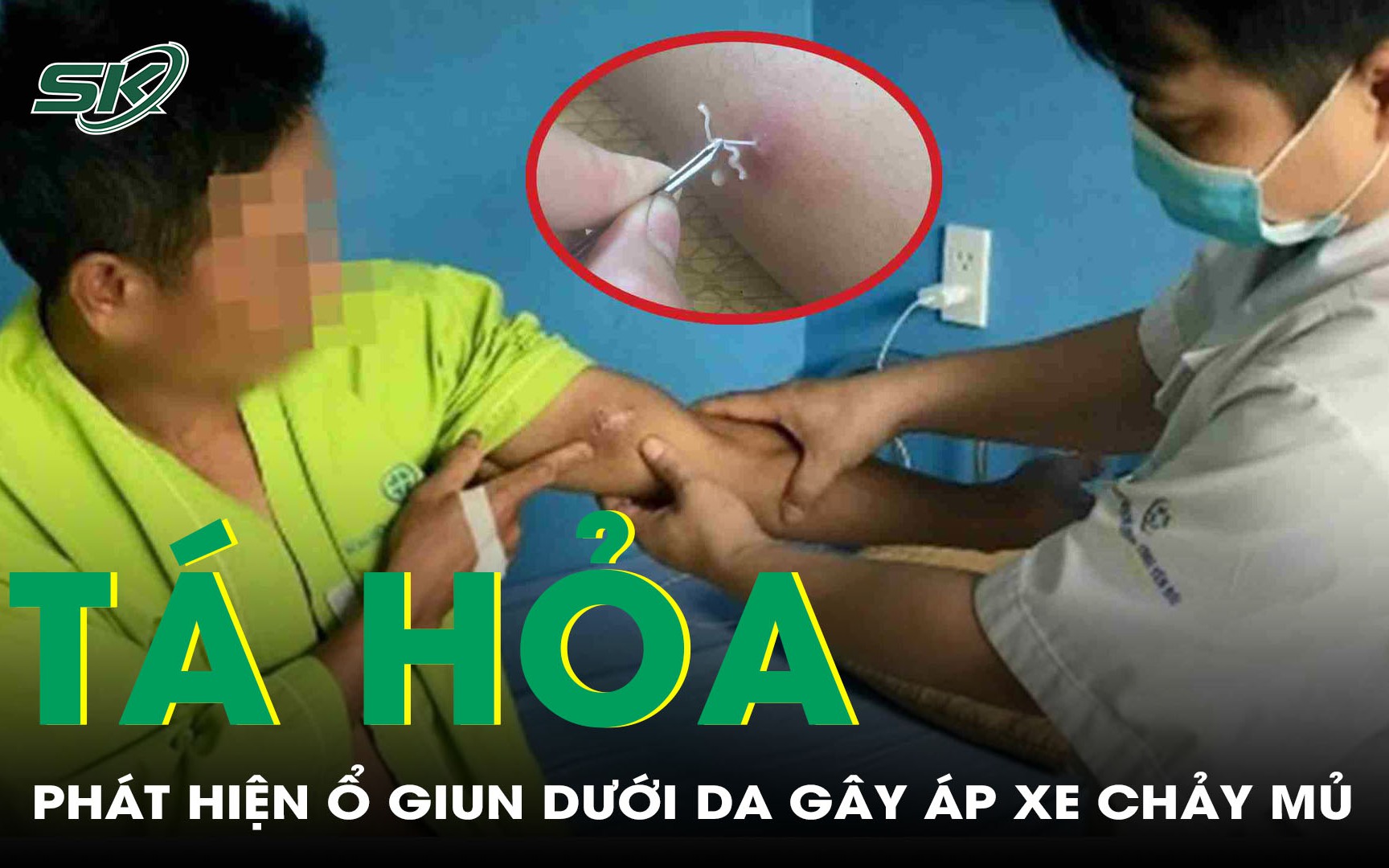 Việt Nam ghi nhận ca thứ 44 mắc giun rồng- Ảnh 2.