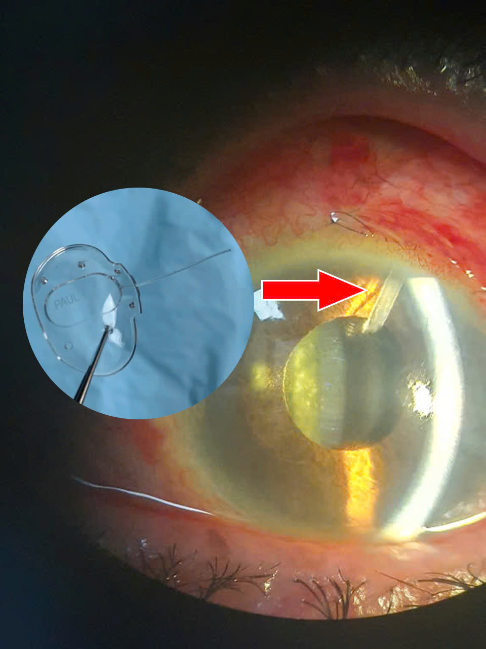 Ca mổ kỹ thuật cao cứu đôi mắt cho bệnh nhân mắc glaucoma- Ảnh 2. Ca mổ kỹ thuật cao cứu đôi mắt cho bệnh nhân mắc glaucoma- Ảnh 2.