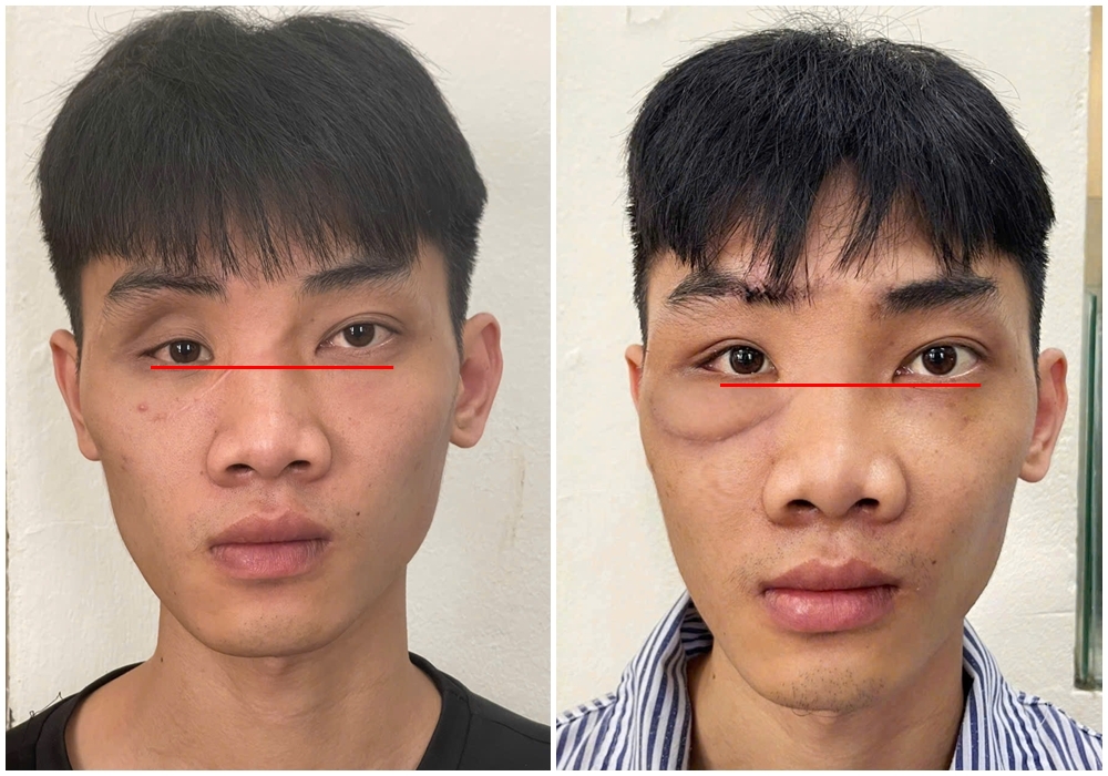 Bệnh viện tuyến tỉnh đầu tiên ứng dụng công nghệ cao trong phẫu thuật tạo hình ổ mắt- Ảnh 2. Bệnh viện tuyến tỉnh đầu tiên ứng dụng công nghệ cao trong phẫu thuật tạo hình ổ mắt- Ảnh 2.