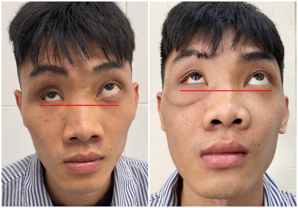 Bệnh viện tuyến tỉnh đầu tiên ứng dụng công nghệ cao trong phẫu thuật tạo hình ổ mắt- Ảnh 3. Bệnh viện tuyến tỉnh đầu tiên ứng dụng công nghệ cao trong phẫu thuật tạo hình ổ mắt- Ảnh 3.