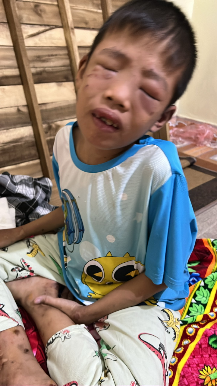 Con lớn bị tâm thần, người cha nghèo cầu cứu cộng đồng để điều trị cho con trai út mắc bệnh hiếm gặp- Ảnh 1. Con lớn bị tâm thần, người cha nghèo cầu cứu cộng đồng để điều trị cho con trai út mắc bệnh hiếm gặp- Ảnh 1.