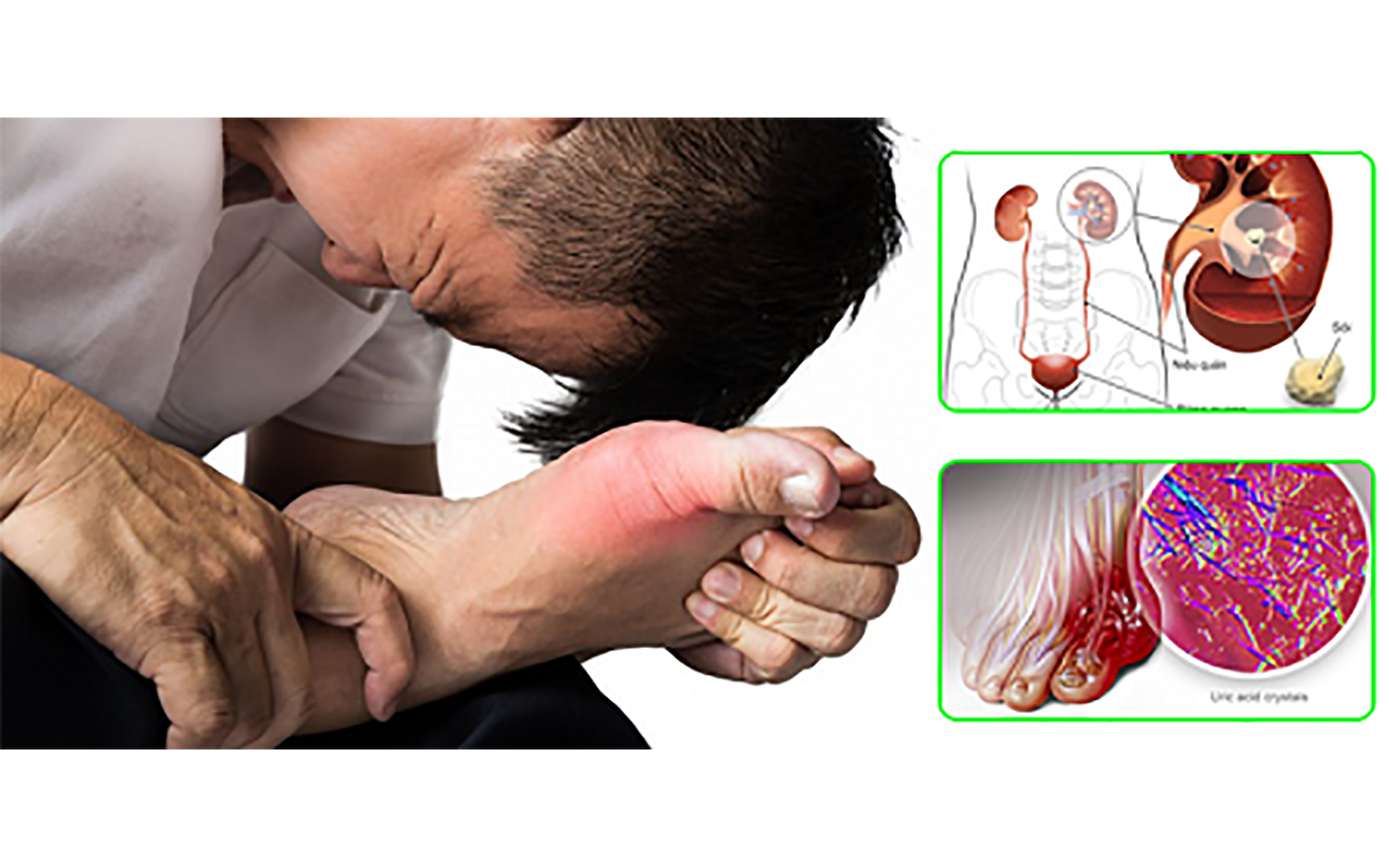 thumb mac benh gout co the bi soi than 1749808549746 17498085514311802421552 17498086115211718831207 0 0 879 1406 crop 1749808618173562808623