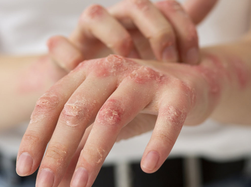 Viêm da tiếp xúc sau ngập lụt do nước bẩn