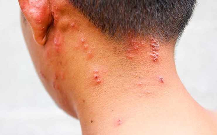 Cách chăm sóc bệnh nhân mắc zona thần kinh mau khỏi