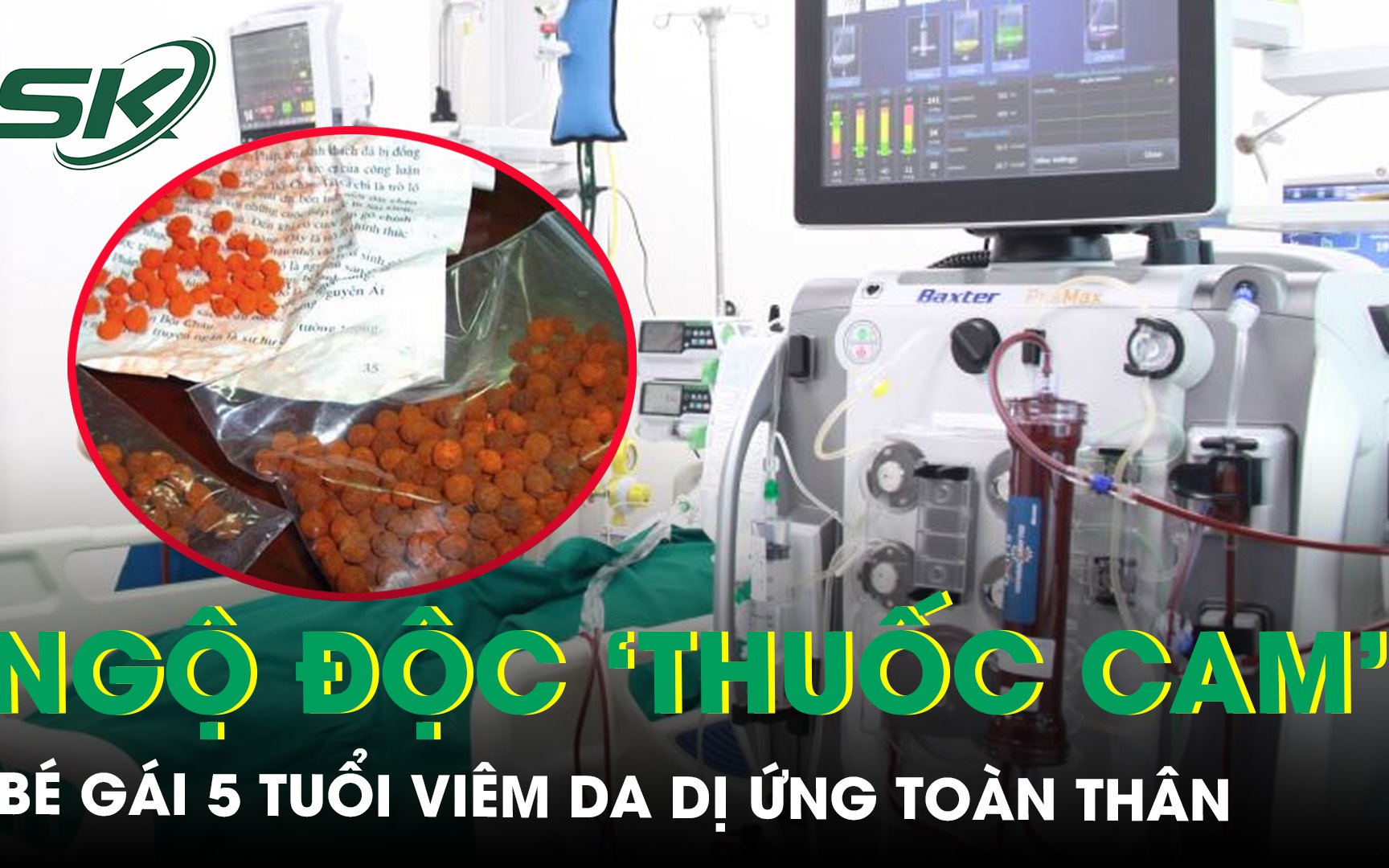 Trẻ em hay mắc các bệnh dị ứng nào?- Ảnh 2. Xót xa bé gái 5 tuổi viêm da dị ứng toàn thân sau 7 ngày bôi và uống ‘thuốc cam’